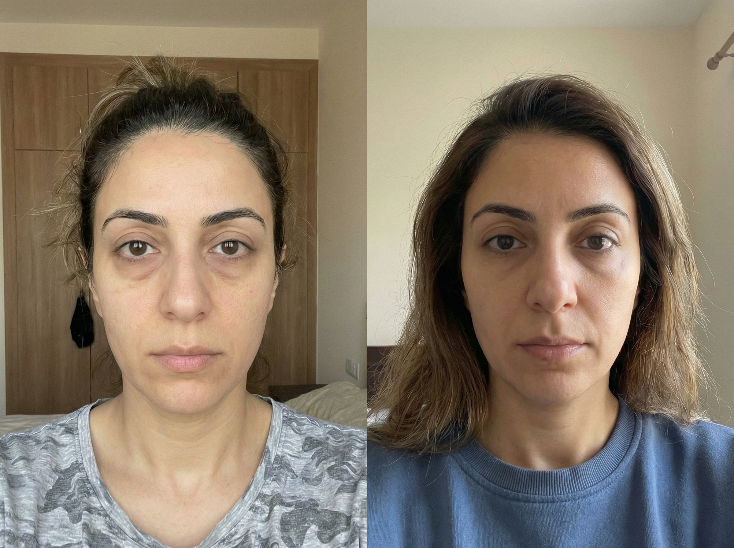 Side-by-side before and after selfies of Nour taken on different days at home, showing subtle, natural-looking improvements in the under-eye area, with changes in hair, clothing, lighting, and background for an authentic, unstaged appearance.